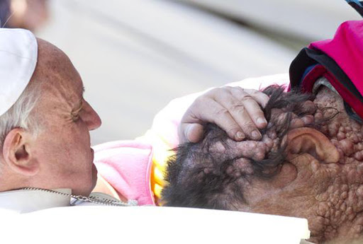 pope francis embraces man with disfigured face