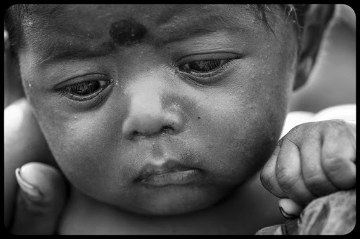 A malnourished baby whose mother is only 13 years old &#8211; © Donna Todd / Calcutta Rescue