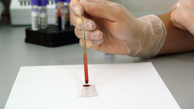 web-blood-test-slide-hiv-publicdomainimages-pd