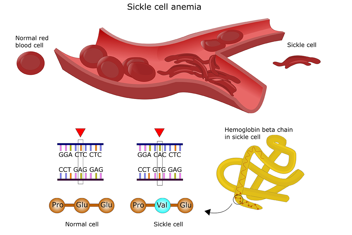 web-sickle-cell-infographic-002-shutterstock_211264888