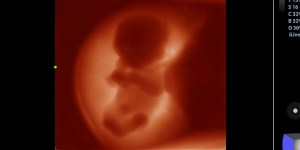 Heart surgery on fetus performed for first time in Ohio