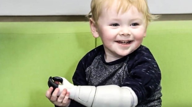 LITTLE BOY WITH 3D PRINTED ARM