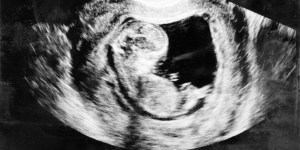 Why abortion can&#8217;t be supported by a scientific argument