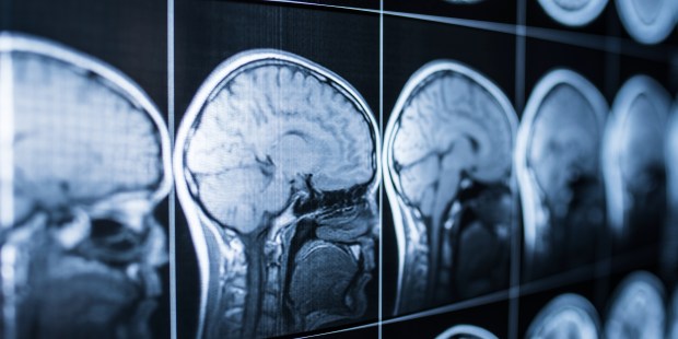Revising brain death standards would be dangerous, ethicists say - Vimarsana News