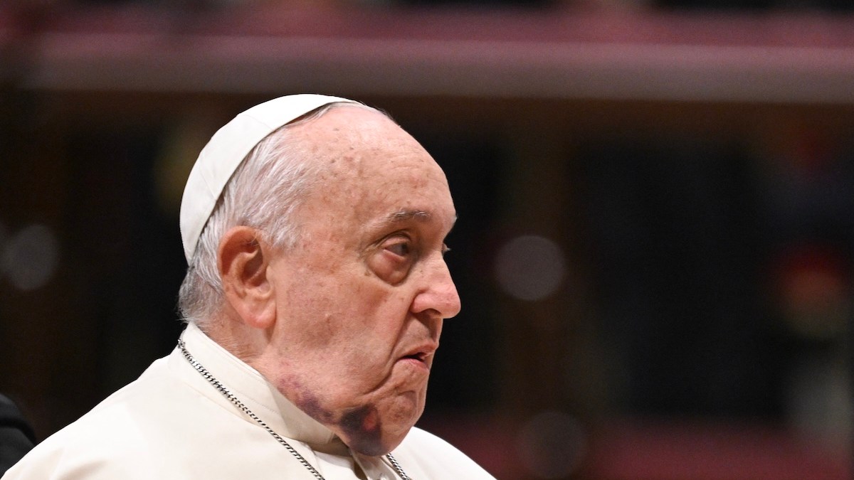 pope-bruised-chin-1.jpg